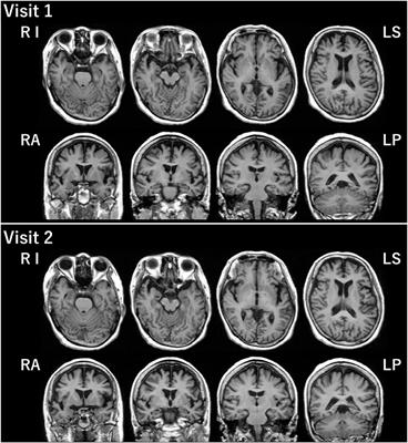 Primary Progressive Aphasia as a Prodromal State of Dementia With Lewy Bodies: A Case Report